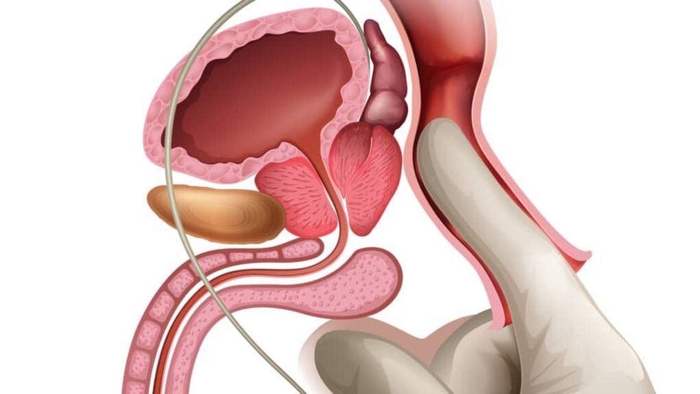 erekciót erősítő masszázs érinti az urethritist az erekció során